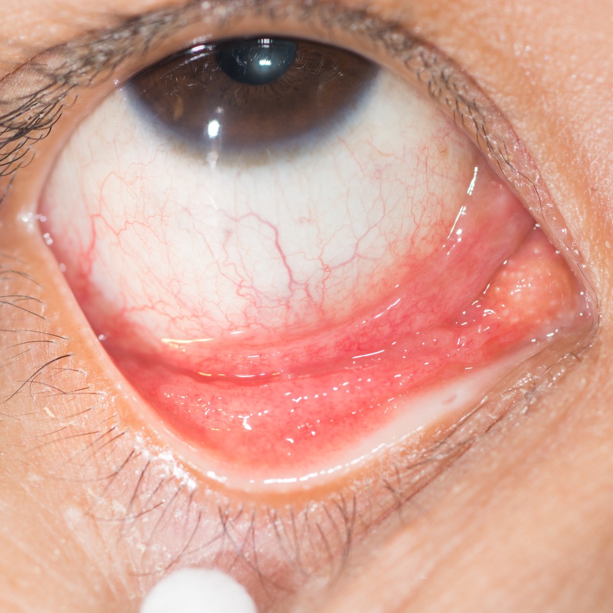 Трансконъюктивальная блефаропластика