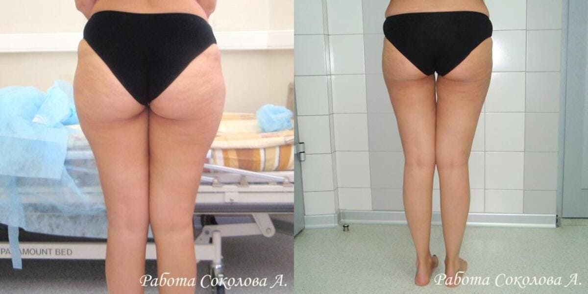 Тумесцентная липосакция