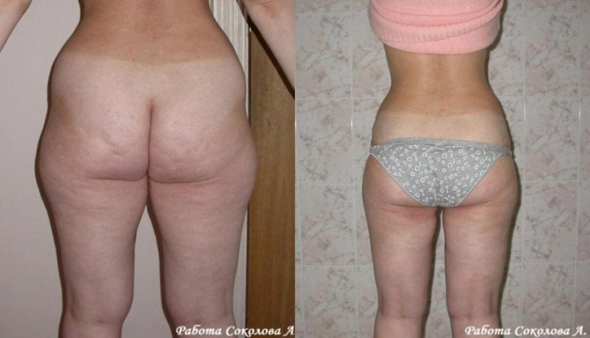 Тумесцентная липосакция