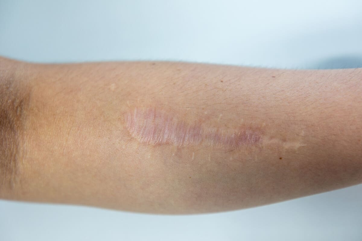 Удаление рубцов