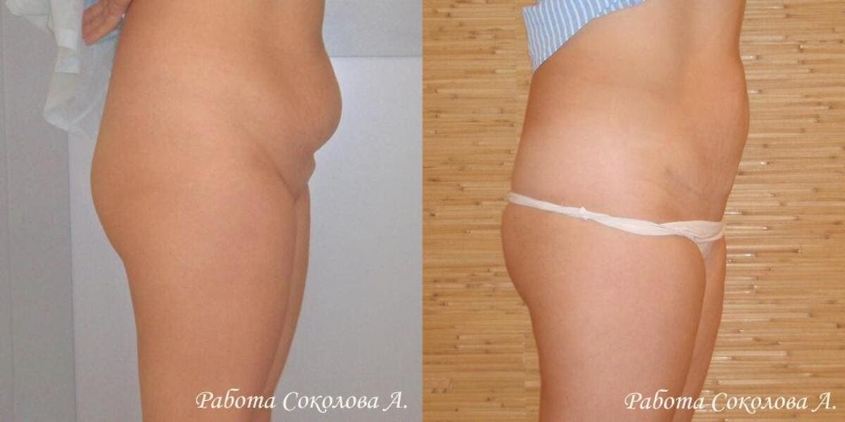 Абдоминопластика