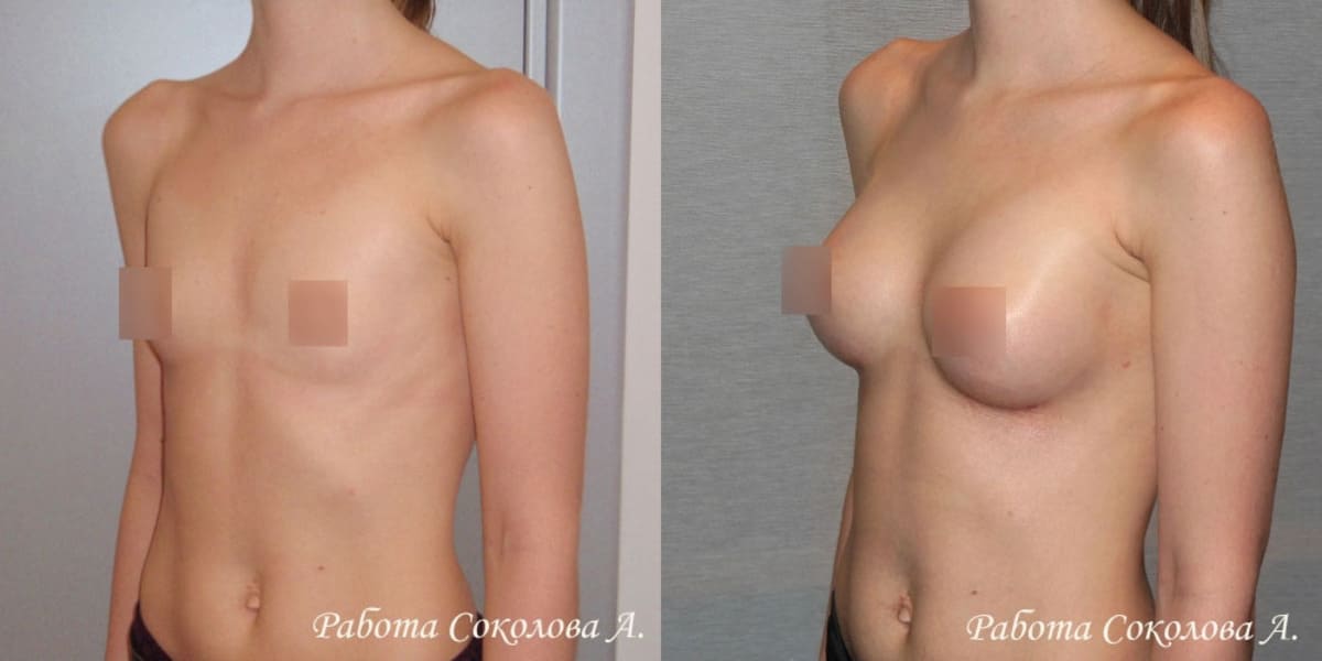 Пластика груди