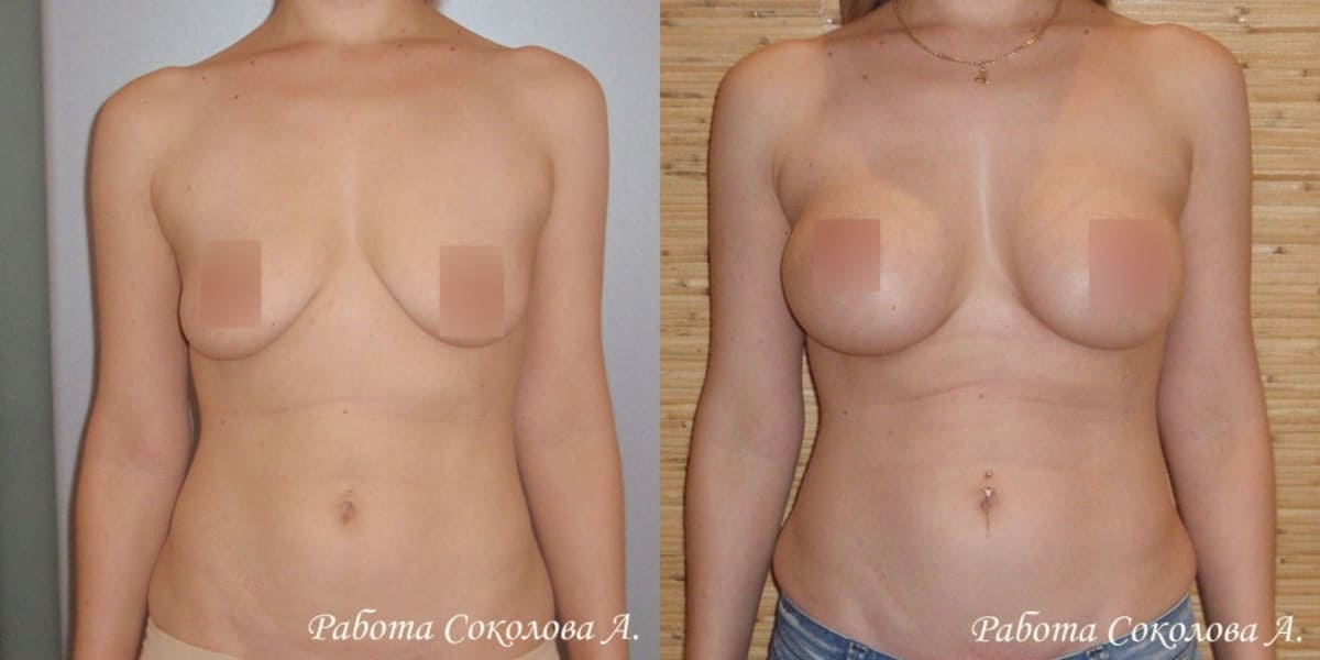 Пластика груди