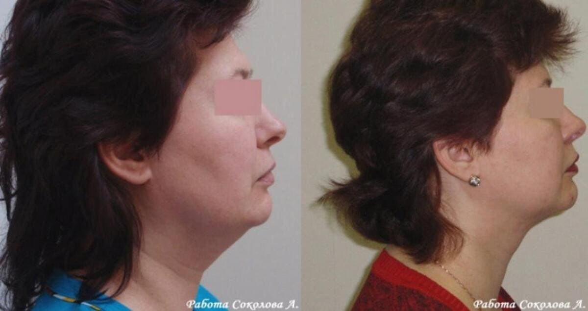 Липоксация