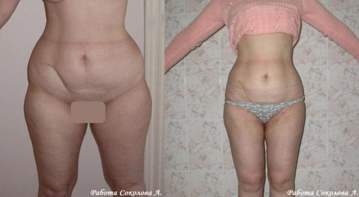 Липоксация